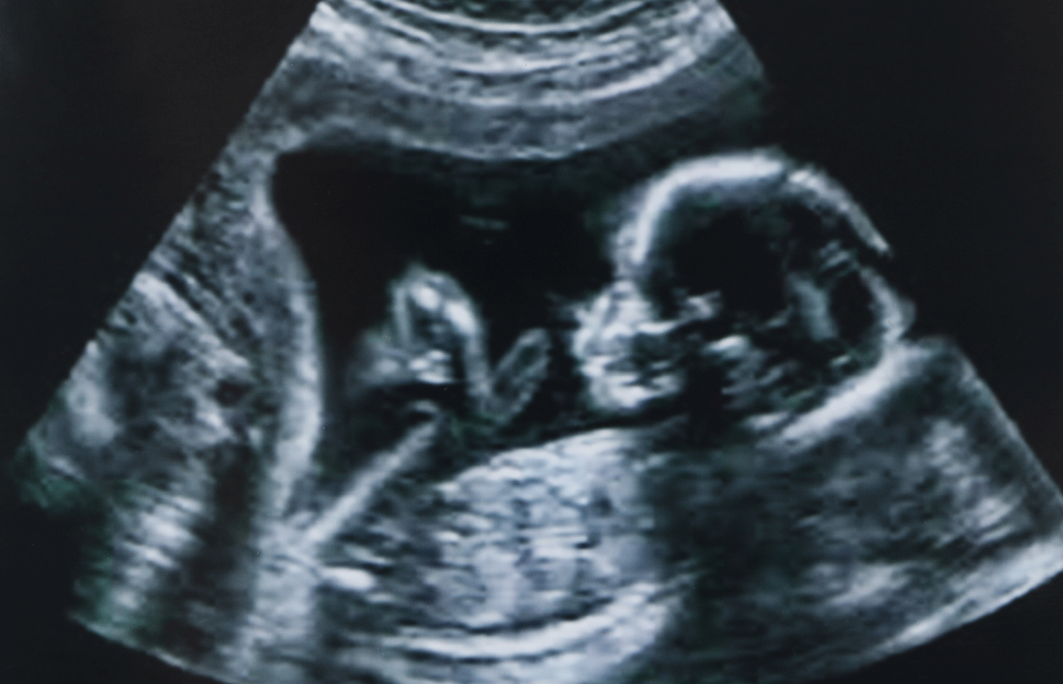 Imagem de ultrassom de uma gestação de alto risco
